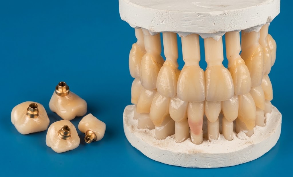 Pròtesi de zirconi estratificada sobre el pilar de fresat, amb corones sobre implant de cargol daurat al costat.