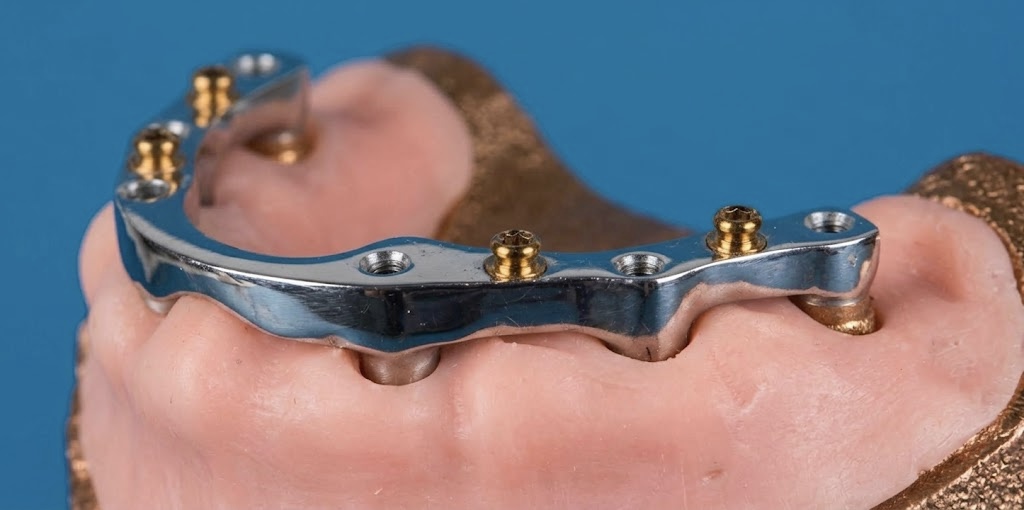 Barra Rhein sobre model de resina amb els implants ferulitzats en un sol cos