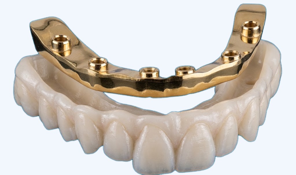 Híbrida sobre implants amb barra de titani anoditzat i arcada de zirconi monolític